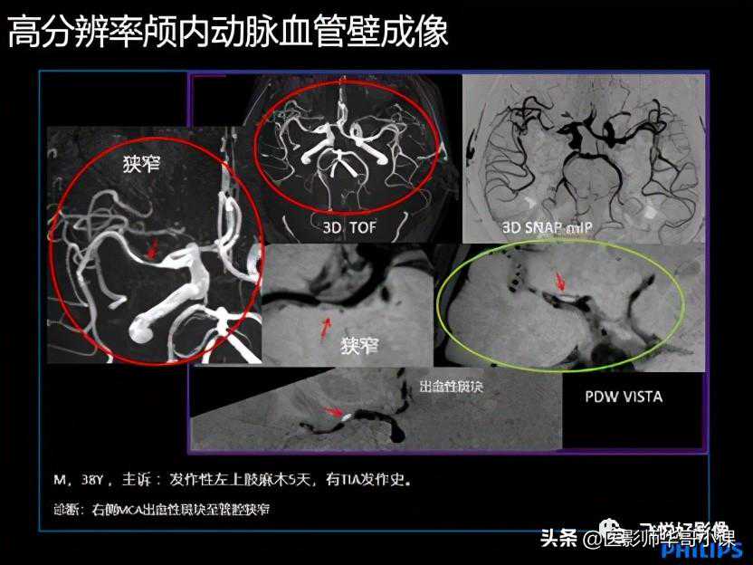 「飞利浦磁共振技术」飞利浦MR用于脑卒中的优势成像技术